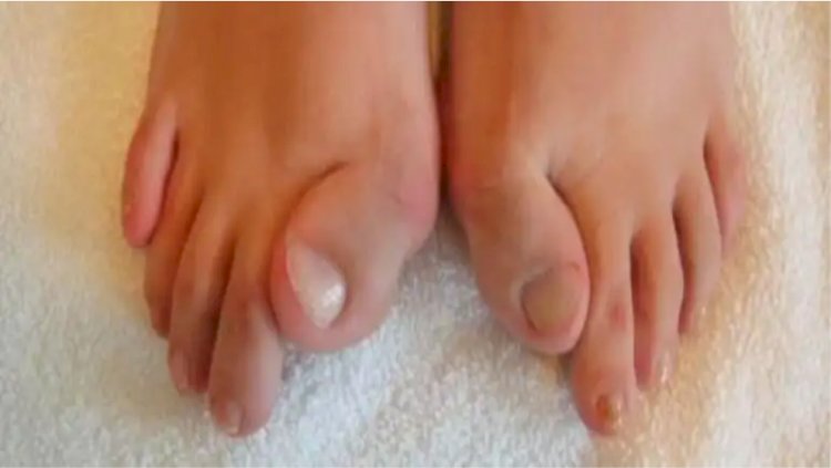 Essa doença rara transforma as pessoas em 'estátuas'